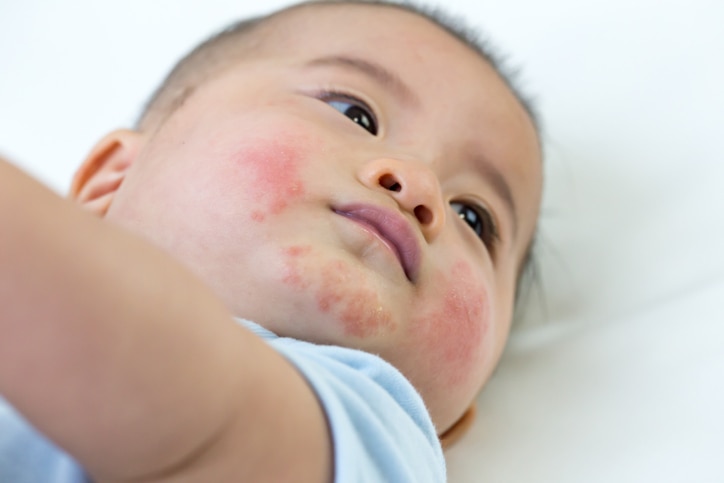 Baby has an allergic reaction to the face, Skin rashes in babies concept