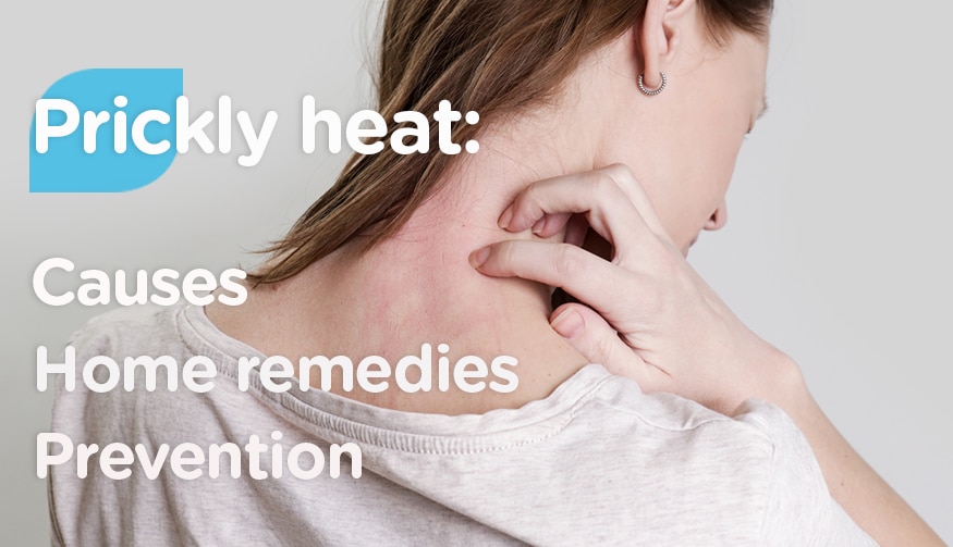 Prickly heat (heat rash)- Causes, home remedies and prevention ...