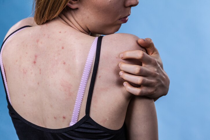 Health problem, skin diseases. Young woman showing her back with acne, red spots. Girl scratching her shoulder with pimples.