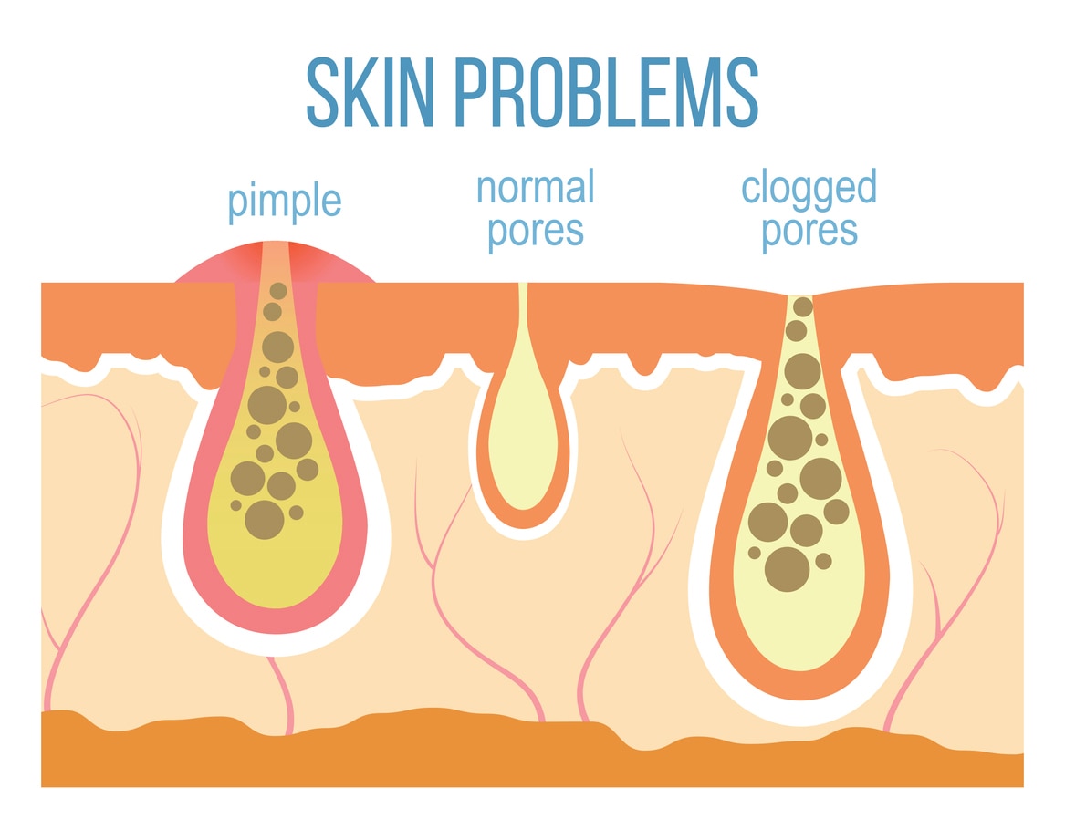 Back acne: Causes, prevention and home remedies